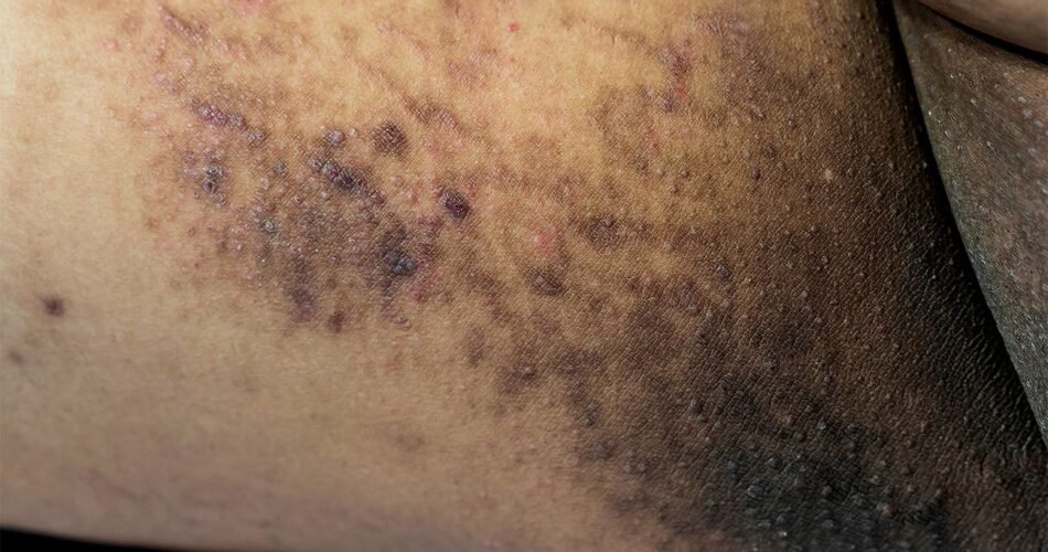 Eczema And Pimples: What If You Have Both