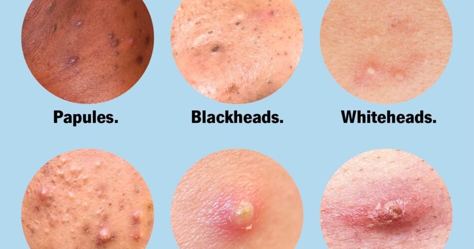 How Do I Know If I Have Acne Or Just Pimples