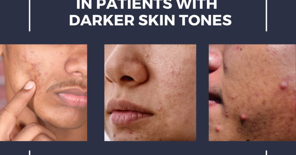What is Acne Vulgaris Treatment