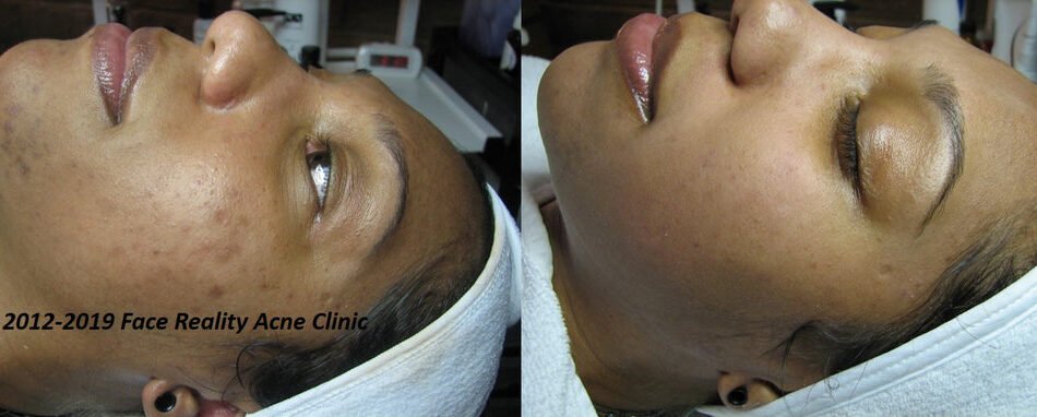 What is the Difference between Acne Scars And Dark Spots