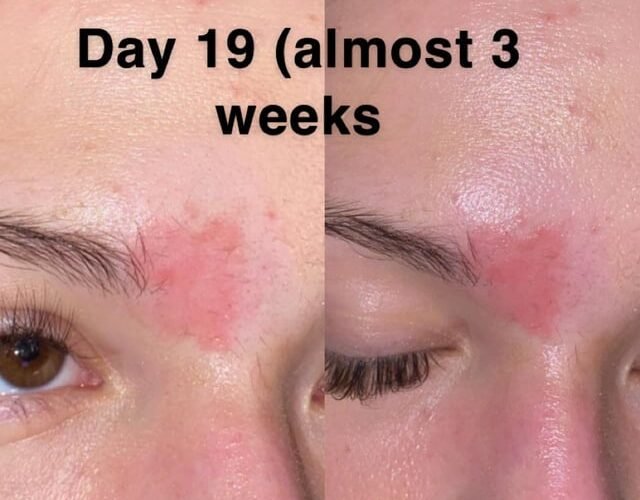 What to Do If Your Face Burns from Acne Medication